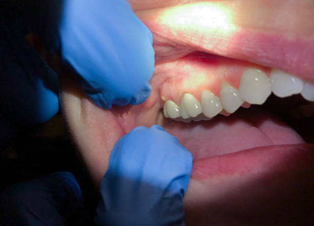 Best Broken or Cracked Tooth Emergency Dentist in Old Westbury, NY
