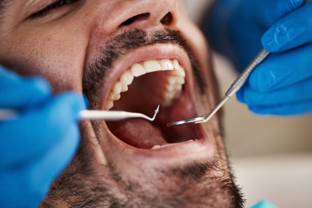 Best Emergency Dentist for Lost Fillings or Crowns in Old Westbury, NY